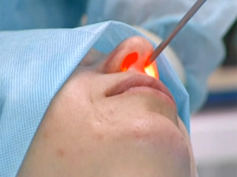 Лазерная полипотомия полости носа лазер