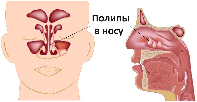 Лазерная полипотомия полости носа